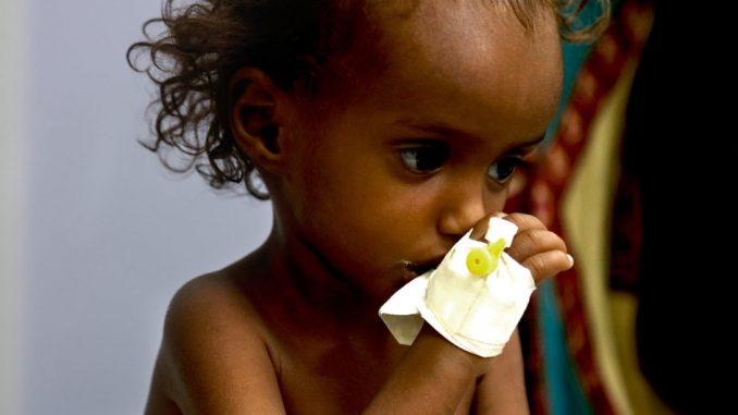 Desnutrición infantil aguda en Yemen